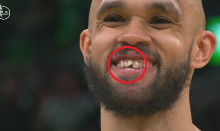 😁怀特:磕掉的牙做了三次根管 现在变得越来越好 这很有趣